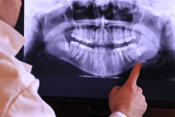 Best Emergency Root Canal Treatment in Irvington, NY